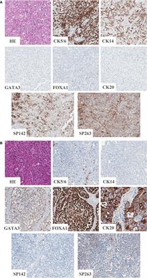 PD-L1 Expression in Muscle-Invasive Urinary Bladder Urothelial Carcinoma According to Basal/Squamous-Like Phenotype